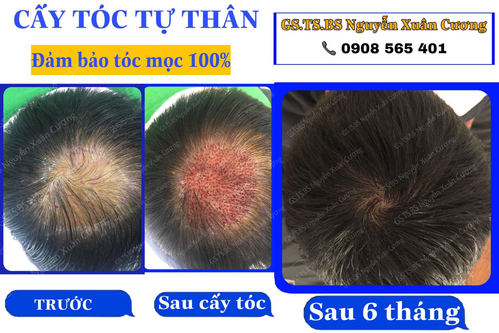 Cấy tóc tự thân giá bao nhiêu nếu làm tại TPHCM