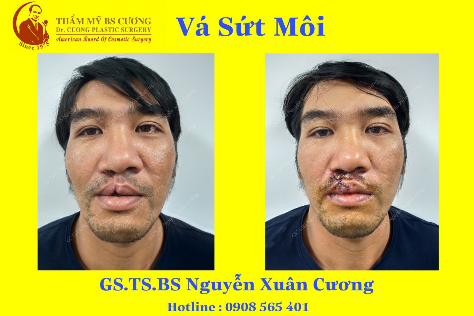 Vá sứt môi tại Bệnh viện Thẩm mỹ Sài gòn