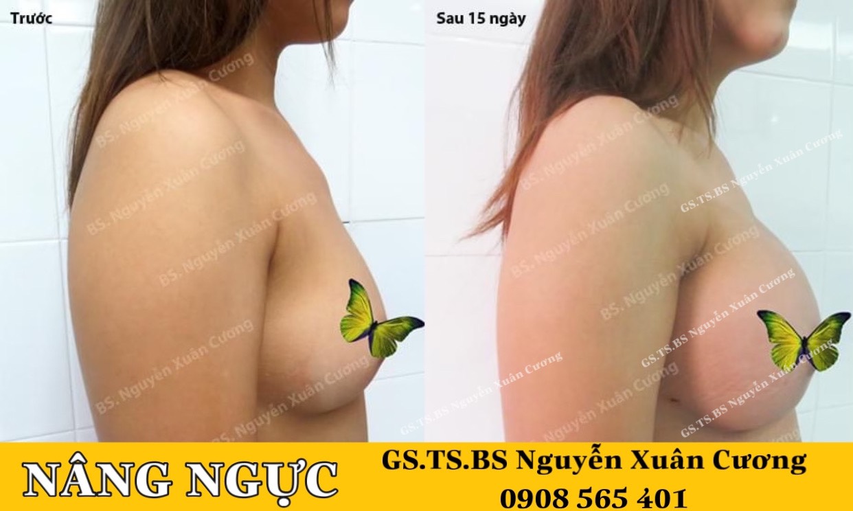 Đặt túi ngực do GS.TS.BS Nguyễn Xuân Cương