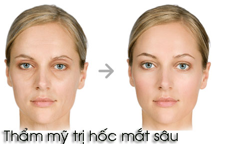 Trị Hốc Mắt Sâu: Giải Pháp Hiệu Quả Và Tự Nhiên