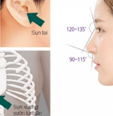 NHỮNG ĐIỀU NGỘ NHẬN TRONG THẨM MỸ NÂNG MŨI SỤN TỰ THÂN