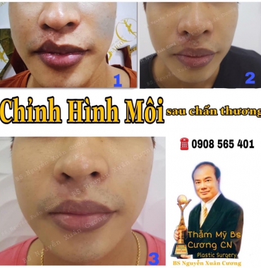 CHỈNH HÌNH MÔI DO CHẤN THƯƠNG