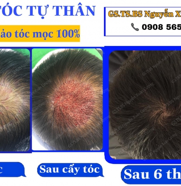 Cấy tóc tự thân giá bao nhiêu tiền