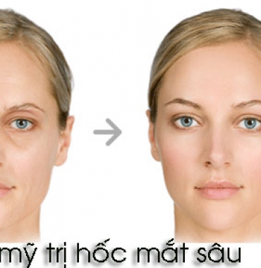 Có nên thẩm mỹ trị hốc mắt sâu hay không và thực hiện ở đâu