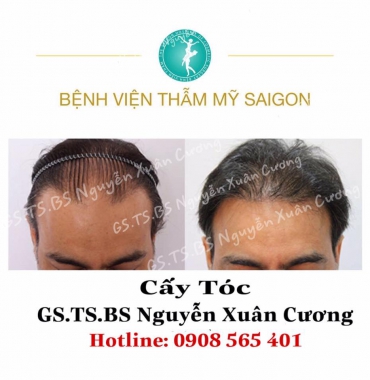 Địa chỉ cấy lông mày tự thân cho nam tốt giá rẻ