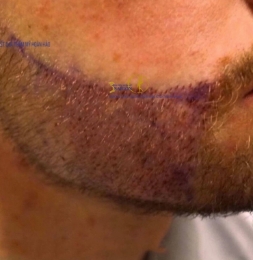 Địa chỉ thẩm mỹ làm râu mọc đều đẹp vĩnh viễn và an toàn