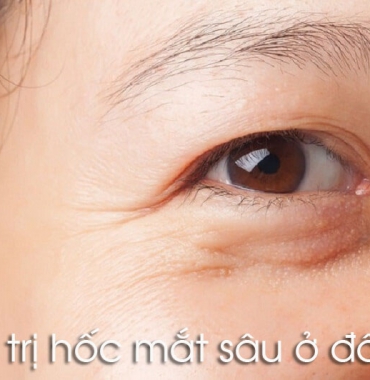 Điều trị hốc mắt sâu ở đâu tại Đồng Nai mà hiệu quả dứt điểm