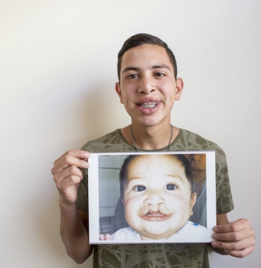 Hở hàm ếch có trị dứt được thẹo không