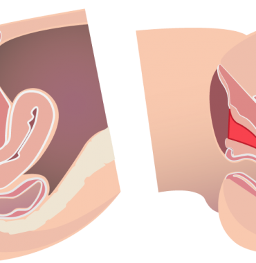 Lợi ích trẻ hóa âm đạo bằng máy Laser