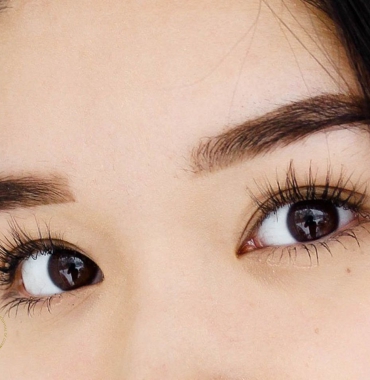 Tìm hiểu về phẫu thuật mở rộng góc mắt