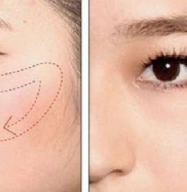 Kinh nghiệm khi nâng xương gò má được an toàn và hiệu quả