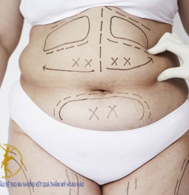 Phẫu thuật hút mỡ tại Bệnh viện Thẩm Mỹ Sài Gòn hiệu quả và tuyệt đối an toàn