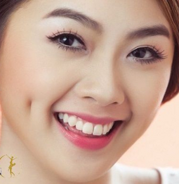 Nét đẹp duyên dáng sau khi thực hiện phương pháp tạo má lúm đồng tiền