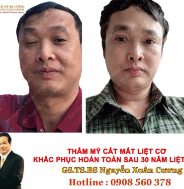 Thẩm mỹ viện chuyên điều trị liệt dây thần kinh số 7 và chấm dứt bệnh méo miệng