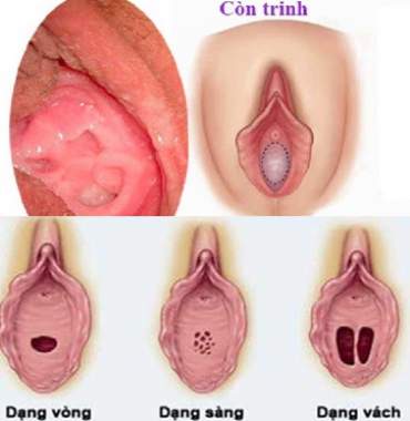 Những ai có thể thẩm mỹ vá trinh và vá trinh ở đâu đẹp đảm bảo bí mật