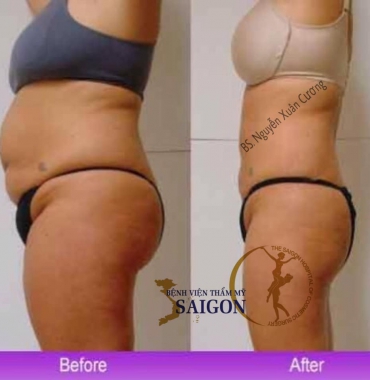 Thu gọn toàn thân tại Bệnh Viện thẩm mỹ Sài Gòn